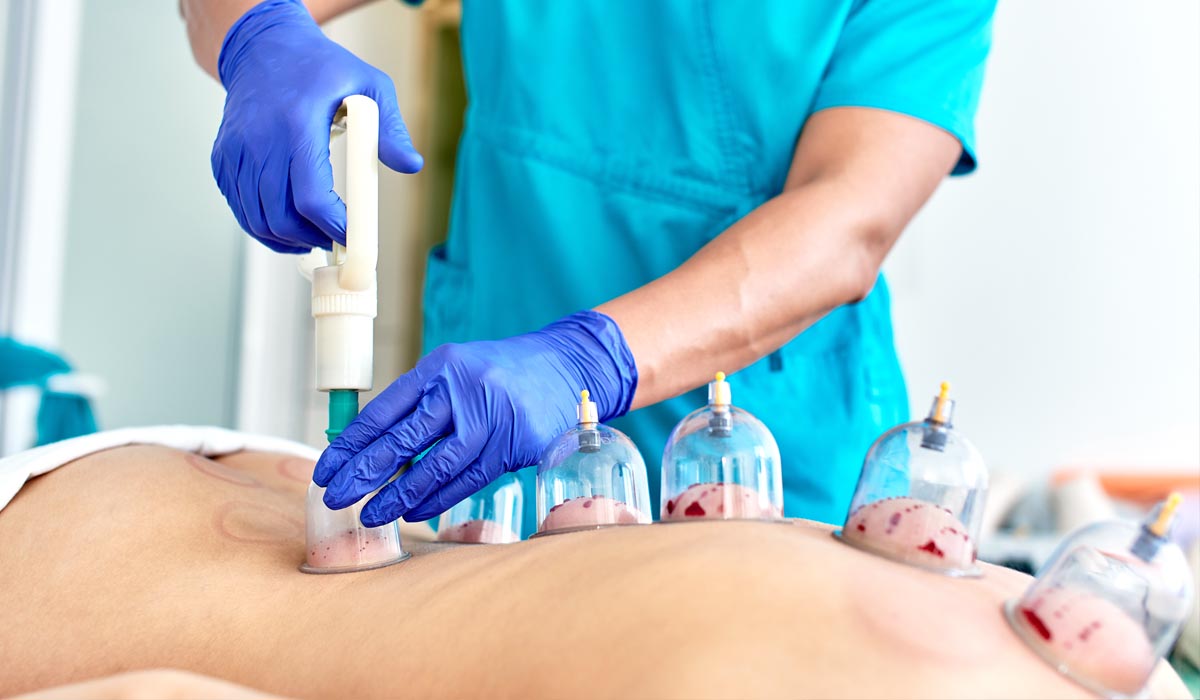 La Formation Hijama ou Cupping Therapy pour vos proches en toute sécurité